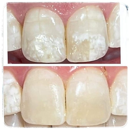 ホワイトスポット治療 茨木市 永井歯科医院 icon