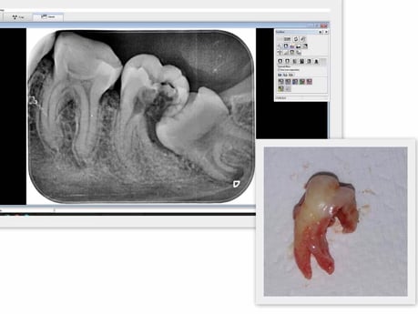 親知らず 抜歯 茨木市 永井歯科