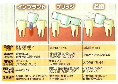 茨木市 インプラント 永井歯科医院 比較 画像