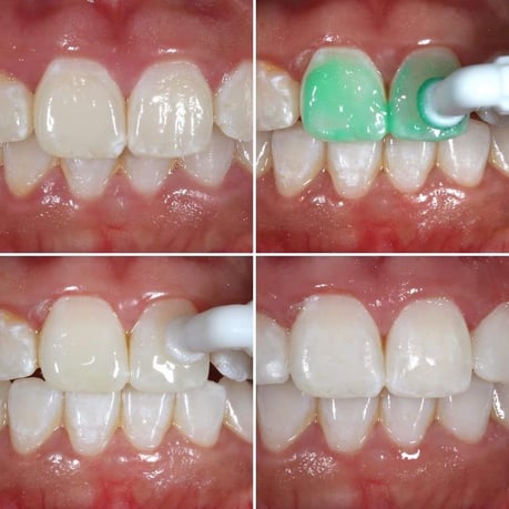 ICON 大阪 永井歯科医院 ホワイトスポット