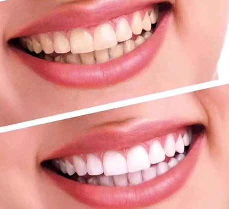 茨木市 ホワイトニング 永井歯科医院 治療実績