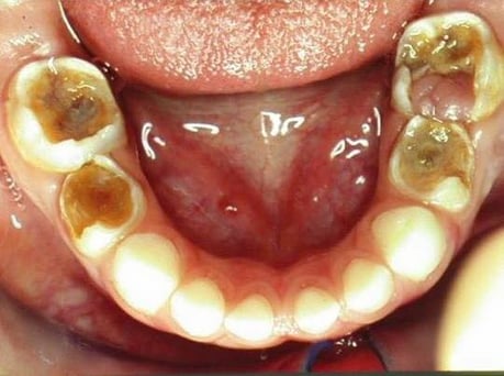 虫歯治療 永井歯科医院 茨木市