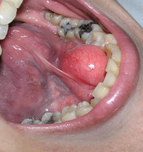 ガマ腫 茨木市 永井歯科医院 口腔外科