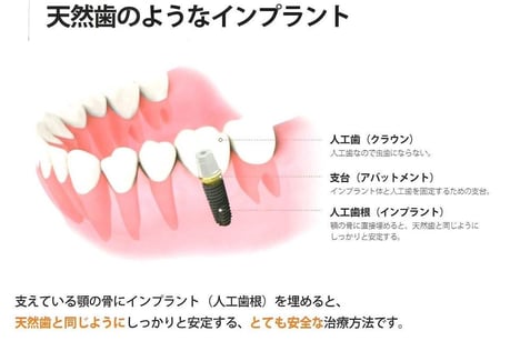 天然歯のようなインプラント 永井歯科医院 茨木市