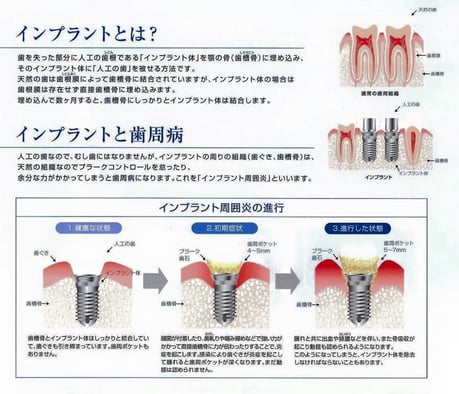 インプラント 永井歯科医院 茨木市 診療科目