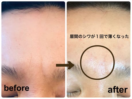 岐阜市で美容鍼灸サロンcotori（ことり）のロングーコースで眉間のシワの改善例