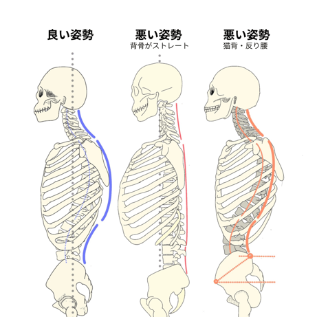 良い姿勢と悪い姿勢（背骨のストレート化、猫背・反り腰）との比較の画像