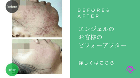 エンジェルのお客様のビフォーアフター