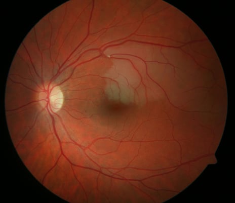 Arterieller Gefäßastverschluss oben (weißer Embolus) mit Netzhautschwellung (gräuliche Areale) mit Beteiligung der Netzhautmitte (Makula)