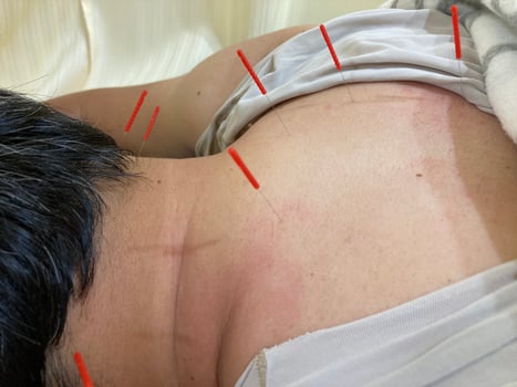 むち打ち 交通事故