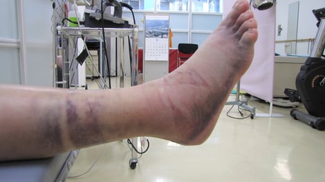 右腓骨骨折　こみね鍼灸整骨院