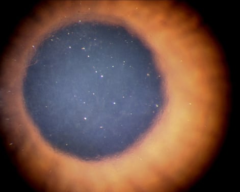 Fuchssche Endotheldystrophie mit deutlicher Trübung der Hornhaut