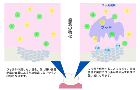 歯質の強化