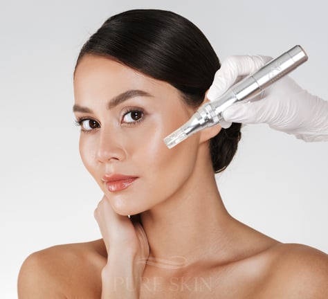 Microneedling, Anti Aging, Micro Needling, Eich, Sempach, Sursee, Kosmetik, medizinische Kosmetik, Akne, Behandlung
