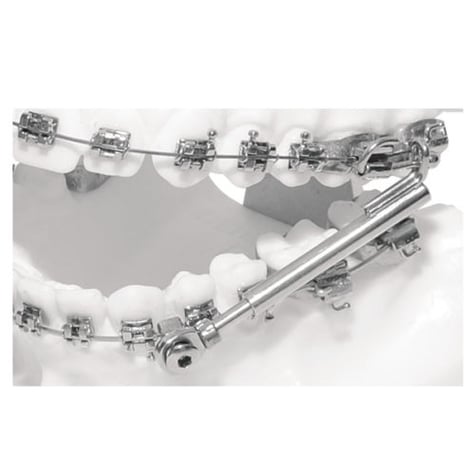 Bild Sabbagh-Universal Spring 2 mit freundlicher Genehmigung der Firma Dentaurum