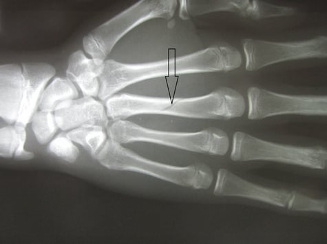 右第三中手骨骨折　保存療法　国分寺こみね鍼灸整骨院