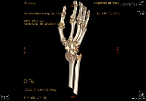 前腕骨下端骨折　橈骨骨折　スミス骨折　国分寺こみね鍼灸整骨院