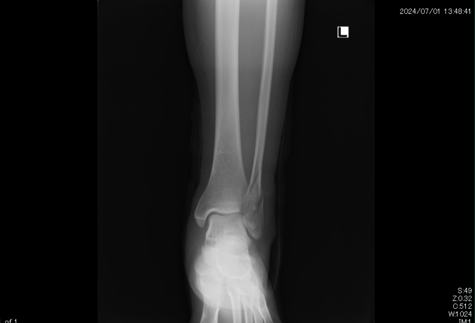 左腓骨遠位端骨折　国分寺　こみね鍼灸整骨院