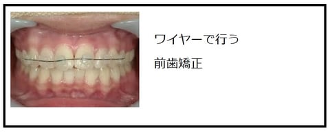 前歯矯正　ワイヤー矯正