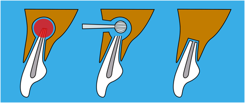 Zeichnung Wurzelspitzenresektion