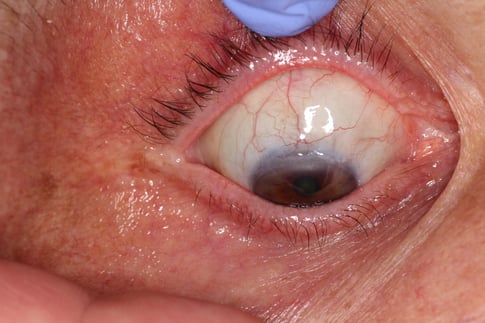 Optimales Sickerkissen 6 Wochen nach Trabekulektomie mit intensivierter Nachbehandlung