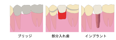 ブリッジ　部分入れ歯　インプラント