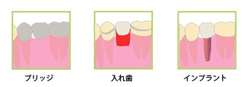ブリッジ　入れ歯　インプラント