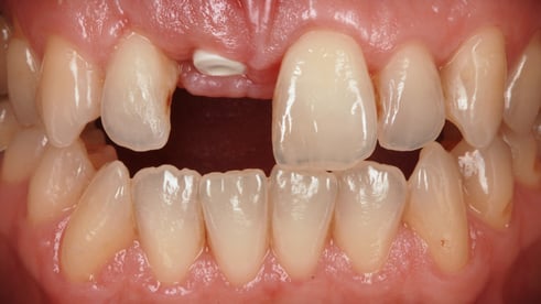 Zahnlücke schließen Implantat