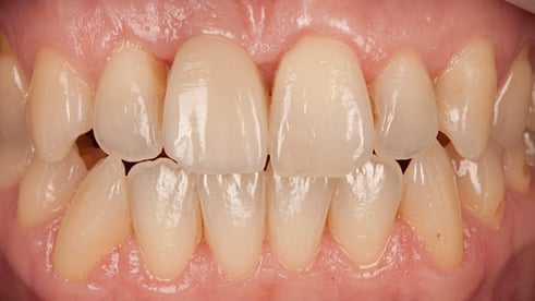 Zahnlücke schließen Implantat