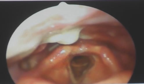 風邪をひいたとき鼻水は喉の背中側に沿って流れ気管に向かっていく