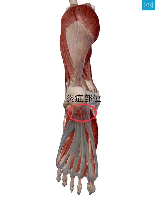足底の痛み　陸上