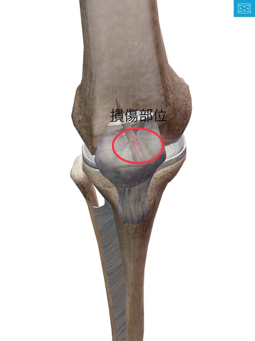 膝のケガ 前十字靭帯断裂