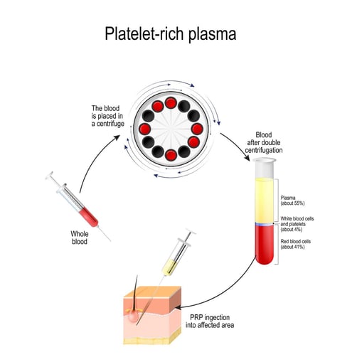 PRP treatment - proctology berlin