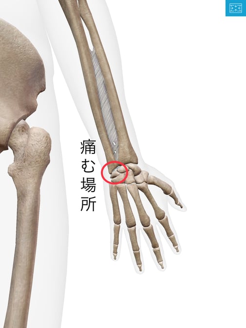 手首の痛み　