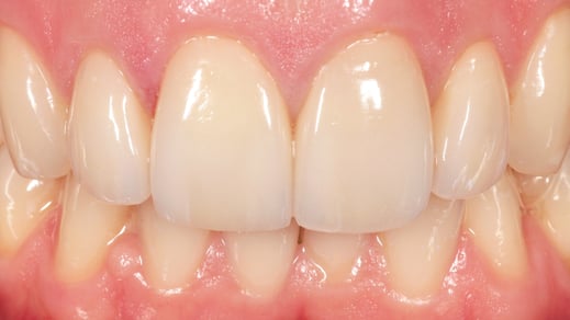 verfärbte Zähne mit Veneers versorgt. www.mb-dental.de
