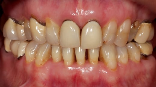 alte Metallkeramikkronen vor der Restauration. www.mb-dental.de