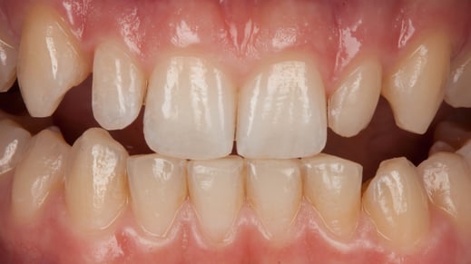 Lockig stehende Schneidezähne / Bild Markus Bongartz