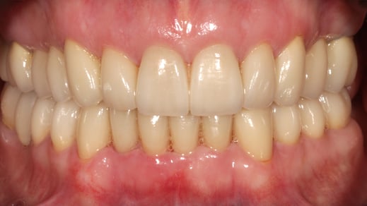 ästhetische Versorgung mit Vollkeramikkronen. www.mb-dental.de