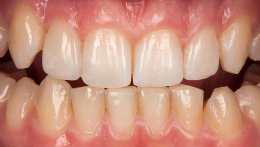 Zahnlücken mit Veneers geschlossen / Bild Markus Bongartz