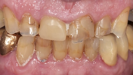 Stark abgenutzte Zähne / Bild Markus Bongartz