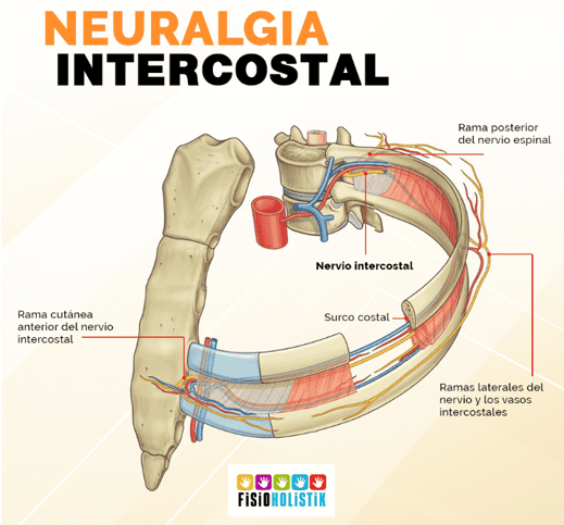 Neuralgia o neuritis intercostal