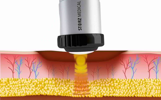 Scheme of shockwave therapy