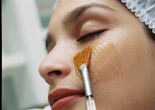 Peeling chimico Padova