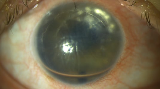 DMEK Patient 1. Tag nach OP. Der Rand des Transplantates kann am oberen Rand erkannt werden, das Transplantat ist kreisrund.