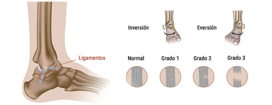 Grados del esguince de tobillo