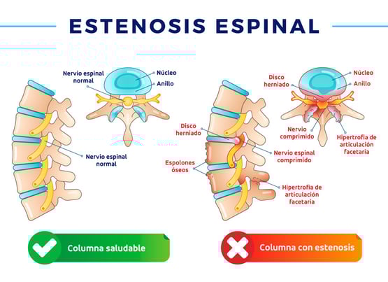 Hernia discal y estenosis  espinal