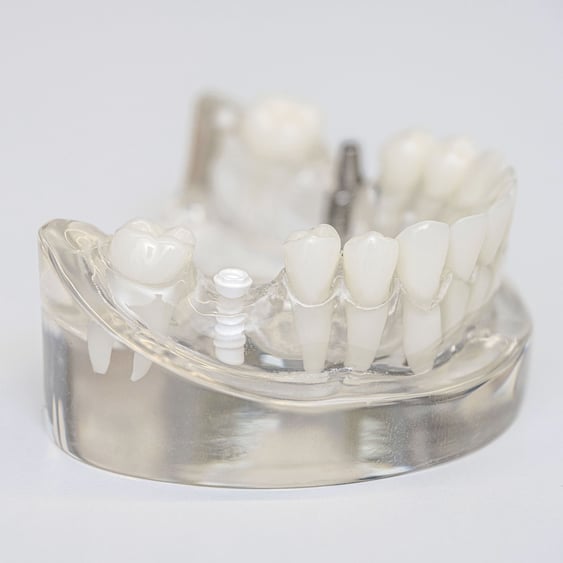 Keramikimplantat (Zirkondiaoxid-Implantate) Oralchirurgie und Implantologie in Schorndorf - has-shadow