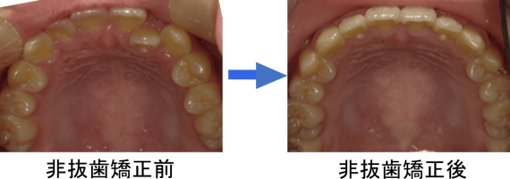 非抜歯矯正