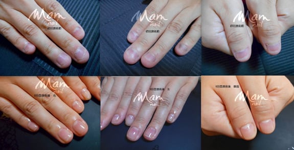 静岡県　富士市　深爪矯正