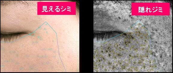 VISIA Evolutionを用いたシミの評価